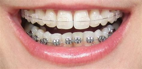 metal brackets vs ceramic|ceramic braces top metal bottom.